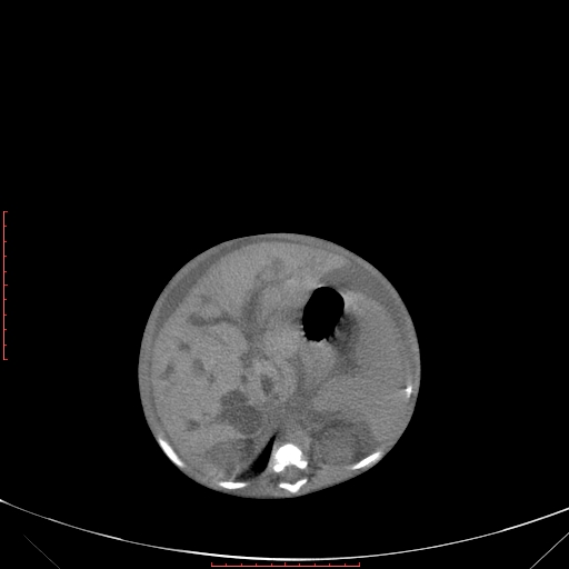 Autosomal recessive polycystic kidney disease associated with Caroli disease (Radiopaedia 61932-69984 Axial non-contrast 144).jpg