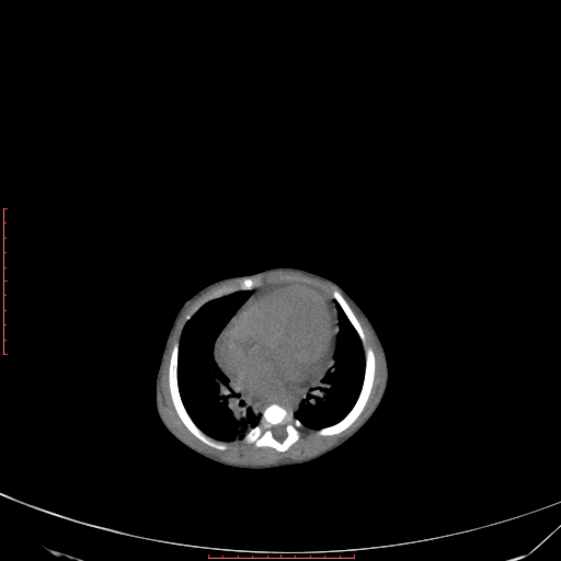 Autosomal recessive polycystic kidney disease associated with Caroli disease (Radiopaedia 61932-69984 Axial non-contrast 69).jpg