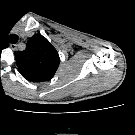 File:Avascular necrosis after fracture dislocations of the proximal humerus (Radiopaedia 88078-104653 D 34).jpg