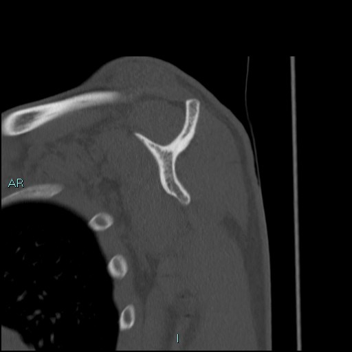 Avascular necrosis after fracture dislocations of the proximal humerus (Radiopaedia 88078-104653 Sagittal bone window 45).jpg