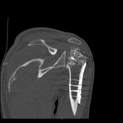 Avascular necrosis after fracture dislocations of the proximal humerus (Radiopaedia 88078-104655 Coronal bone window 68).jpg