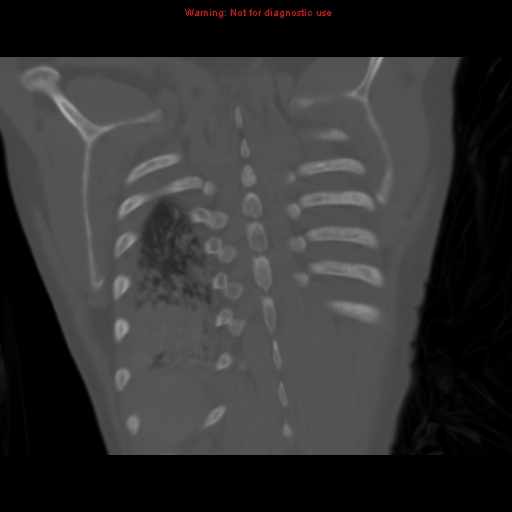 File:Avascular necrosis in sickle cell disease (Radiopaedia 17448-17152 Coronal bone window 110).jpg