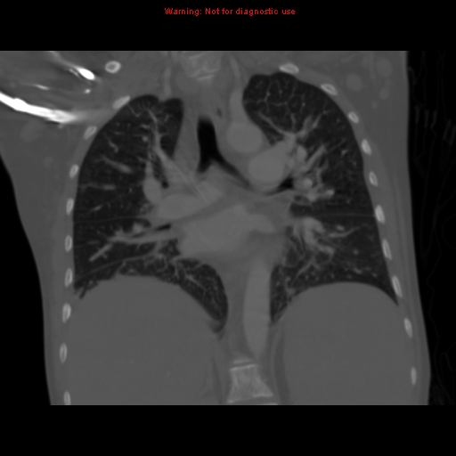 File:Avascular necrosis in sickle cell disease (Radiopaedia 17448-17152 Coronal bone window 72).jpg