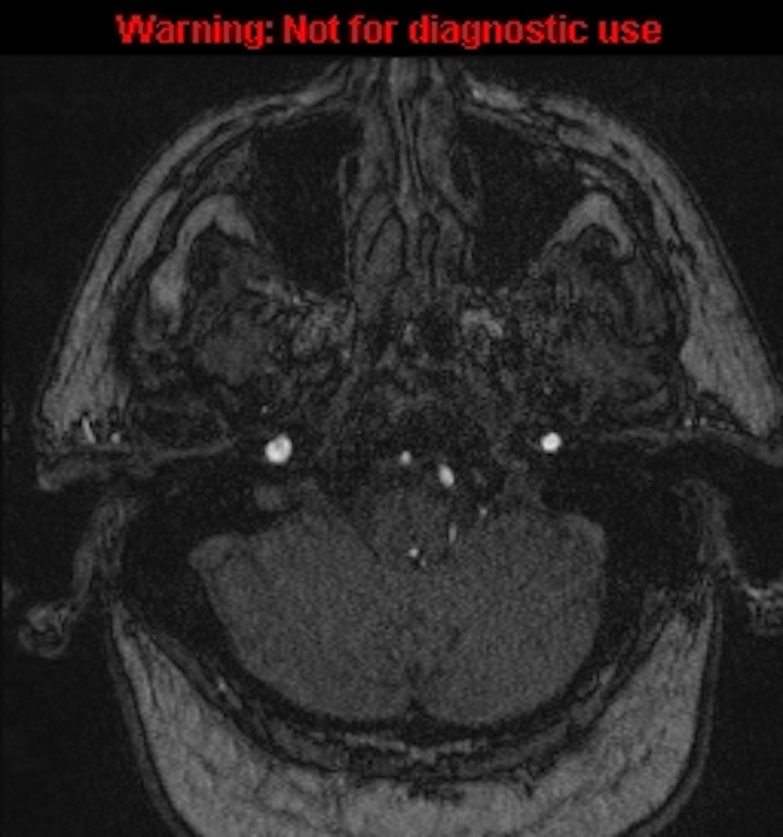 Azygos anterior cerebral artery (Radiopaedia 59325-66677 Axial MRA 20).jpg