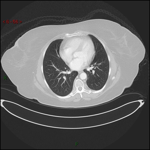 File:Azygos fissure and lobe (Radiopaedia 47620-52278 Axial lung window 56).jpg