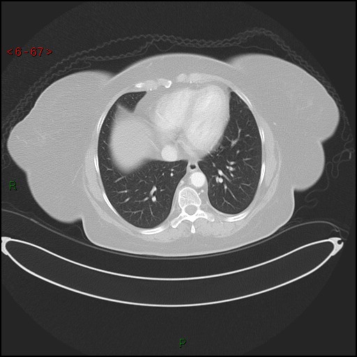 Azygos fissure and lobe (Radiopaedia 47620-52278 Axial lung window 67).jpg