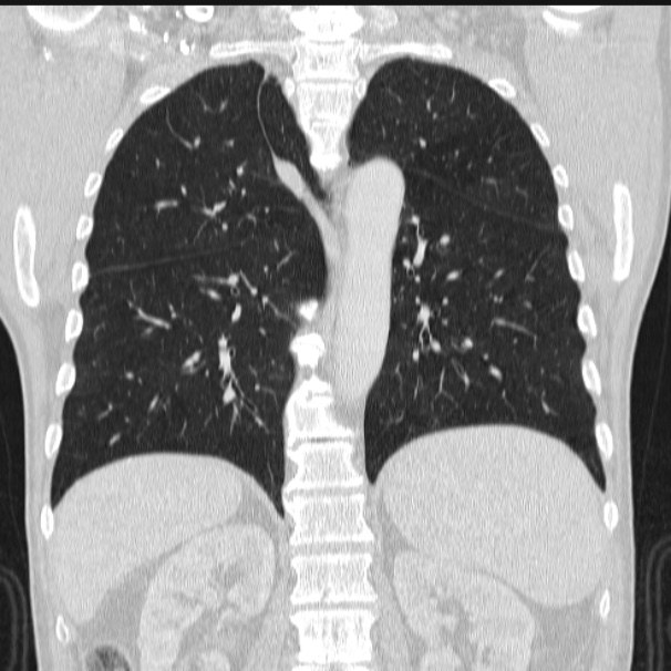 Azygos lobe (Radiopaedia 38259-40275 Coronal lung window 54).jpg