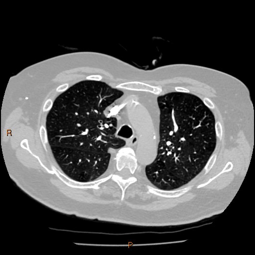 Azygos lobe (Radiopaedia 40161-42821 Axial lung window 21).jpg