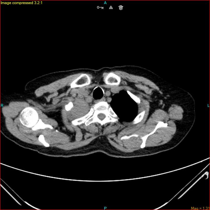 Azygos vein aneurysm (Radiopaedia 77824-90130 A 9).jpg