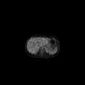 B-cell lymphoma of the mesentery (Radiopaedia 65743-74868 18F-FDG PET-CT 168).jpg