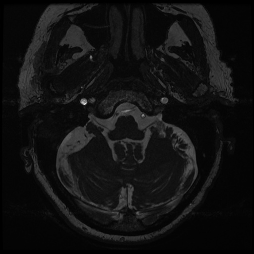 File:Balo concentric sclerosis (Radiopaedia 53875-59982 Axial T2 FIESTA 15).jpg
