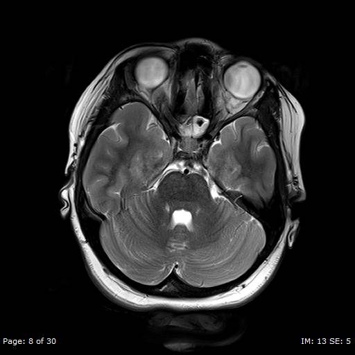 File:Balo concentric sclerosis (Radiopaedia 61637-69636 Axial T2 8).jpg