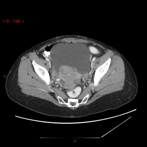 Bartholin gland cyst (Radiopaedia 54904-61181 A 49).jpg