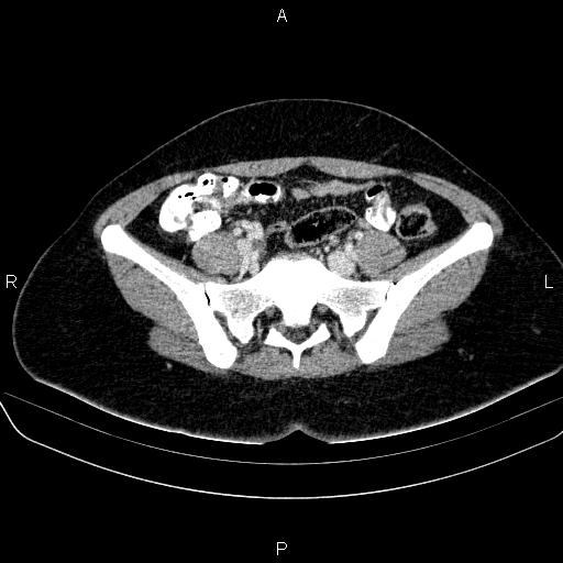 File:Bartholin gland cyst (Radiopaedia 62635-70930 Axial Post contrast 20).jpg