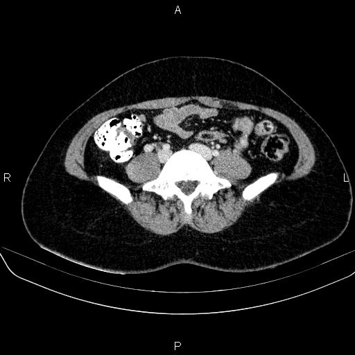 File:Bartholin gland cyst (Radiopaedia 62635-70930 Axial Post contrast 3).jpg