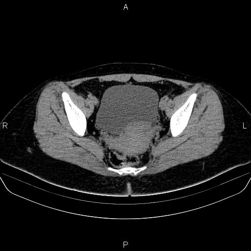 File:Bartholin gland cyst (Radiopaedia 62635-70930 Axial non-contrast 50).jpg