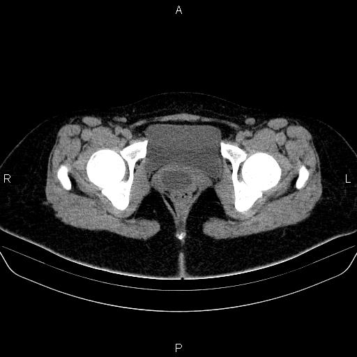 Bartholin gland cyst (Radiopaedia 62635-70930 Axial non-contrast 72).jpg