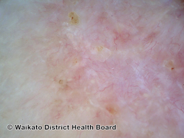 File:Basal cell carcinoma dermoscopy (DermNet NZ bcc-arm-3-wdhb).jpg
