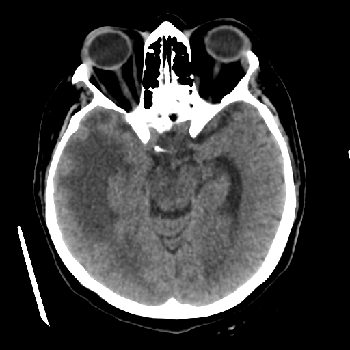 Basal ganglia metastasis (Radiopaedia 78928-91830 Axial non-contrast 27).png