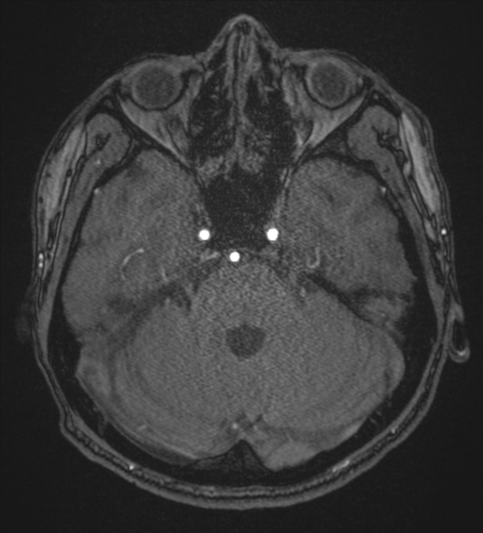 Basal ganglia subacute infarct (Radiopaedia 80201-93521 Axial MRA 26).png