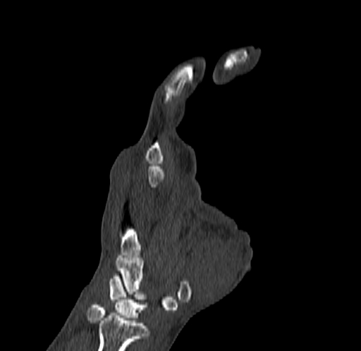 Base of 2nd metacarpal fracture (Radiopaedia 73741-84544 Coronal bone window 37).jpg