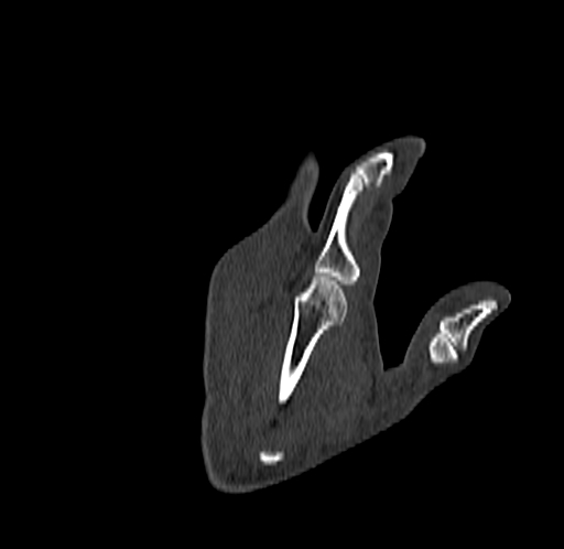 Base of 2nd metacarpal fracture (Radiopaedia 73741-84544 Coronal bone window 75).jpg