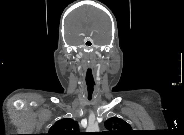 File:Basilar artery aneurysm (Radiopaedia 56261-62932 B 16).jpg