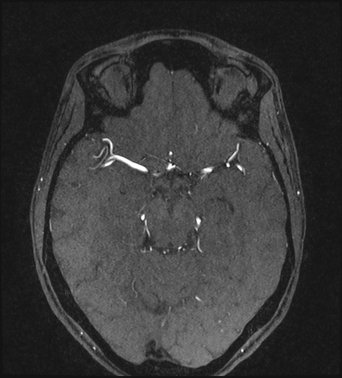 Basilar artery perforator aneurysm (Radiopaedia 82455-97733 Axial MRA 106).jpg