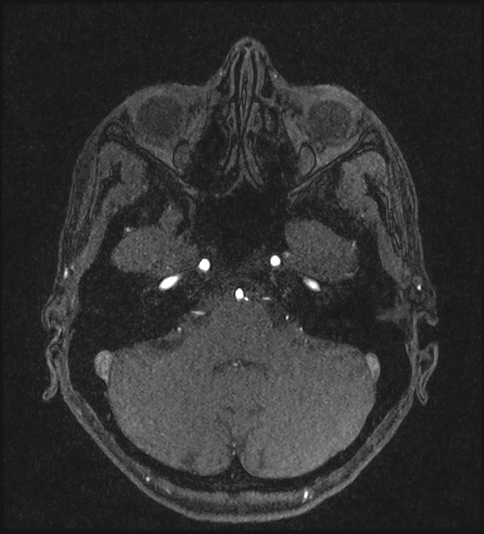 Basilar artery perforator aneurysm (Radiopaedia 82455-97733 Axial MRA 62).jpg