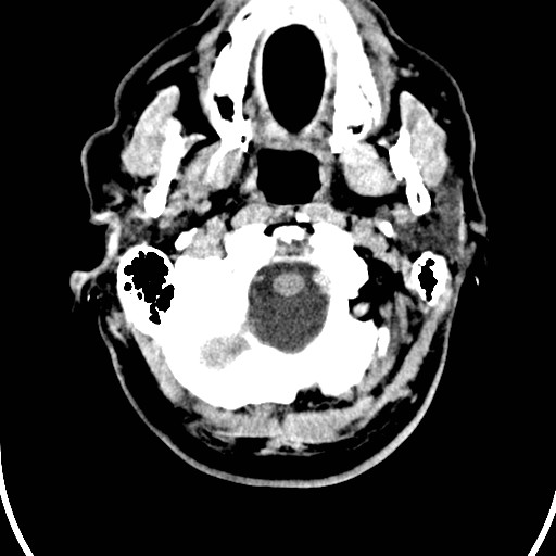 File:Basilar artery thrombosis (Radiopaedia 26986-27162 Axial non-contrast 2).jpg