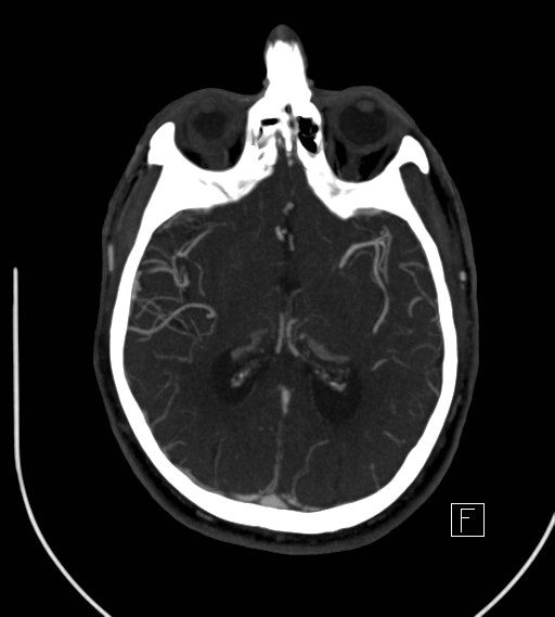 Basilar artery thrombosis (Radiopaedia 26986-27163 A 47).jpg