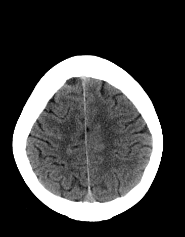 File:Basilar tip aneurysm with coiling (Radiopaedia 53912-60033 Axial 14).jpg