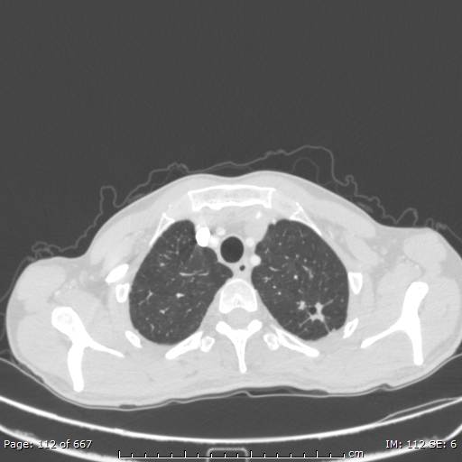 Behçet disease (Radiopaedia 44247-47889 Axial lung window 9).jpg