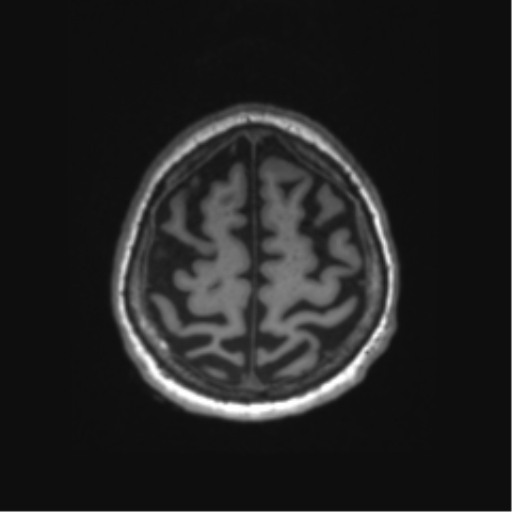 Behavioral variant frontotemporal dementia and late onset schizophrenia (Radiopaedia 52197-58083 Axial T1 6).png