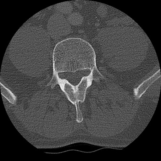 Benign post-traumatic pseudopneumoperitoneum (Radiopaedia 71199-81495 Axial bone window 258).jpg