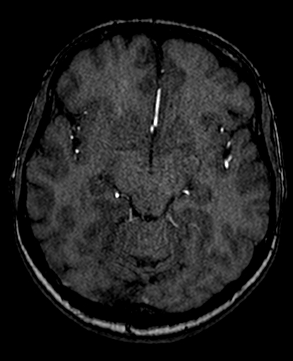 File:Berry aneurysm of the terminal internal carotid artery (Radiopaedia 88286-104918 Axial TOF 111).jpg