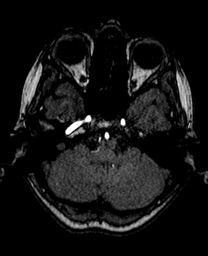 File:Berry aneurysm of the terminal internal carotid artery (Radiopaedia 88286-104918 Axial TOF 69).jpg