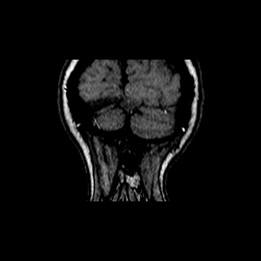 File:Berry aneurysm of the terminal internal carotid artery (Radiopaedia 88286-104918 Coronal TOF 115).jpg