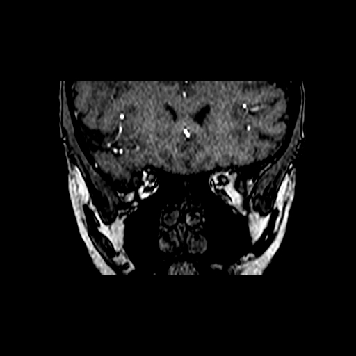 Berry aneurysm of the terminal internal carotid artery (Radiopaedia 88286-104918 Coronal TOF 16).jpg