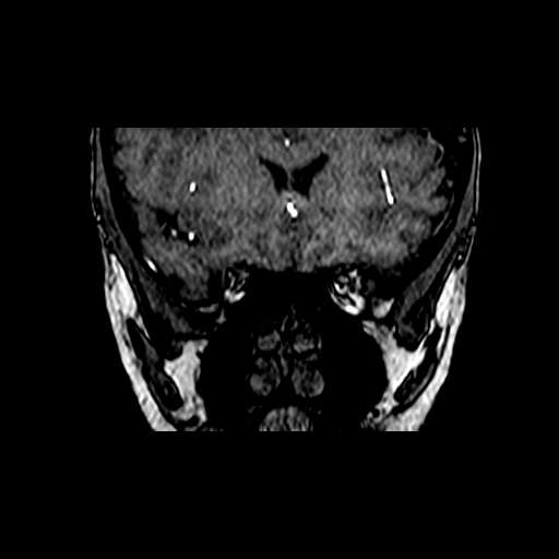 Berry aneurysm of the terminal internal carotid artery (Radiopaedia 88286-104918 Coronal TOF 19).jpg