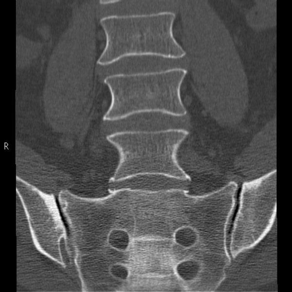 Bertolotti syndrome (Radiopaedia 24864-25128 Coronal bone window 17).jpg