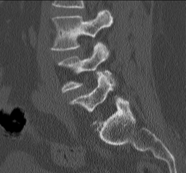Bertolotti syndrome (Radiopaedia 24864-25128 Sagittal bone window 19).jpg