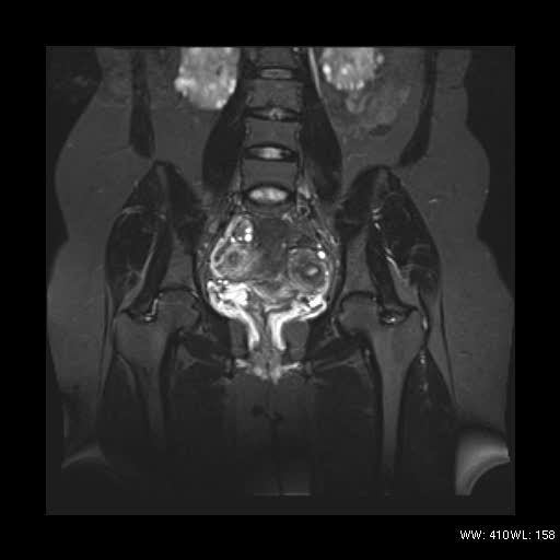 File:Bicornuate uterus- on MRI (Radiopaedia 49206-54297 Coronal STIR 10).jpg