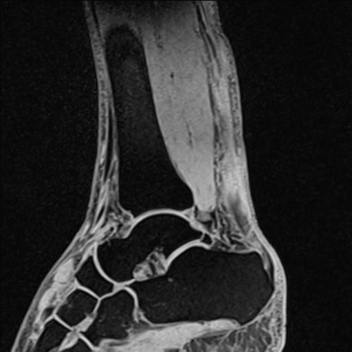 Bilateral Achilles tendon complete tear (Radiopaedia 81344-95051 Sagittal WE - Left 65).jpg