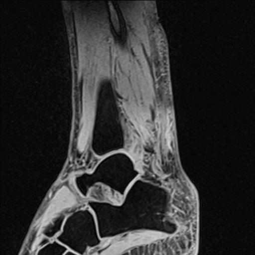 Bilateral Achilles tendon complete tear (Radiopaedia 81344-95051 Sagittal WE - Left 77).jpg