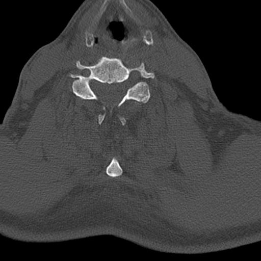 File:Bilateral C6-7 locked facet dislocation (Radiopaedia 28506-28748 Axial bone window 17).jpeg