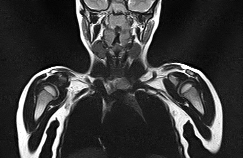 File:Bilateral Sprengel deformity with Klippel-Feil syndrome (Radiopaedia 66395-75650 Coronal T2 8).jpg