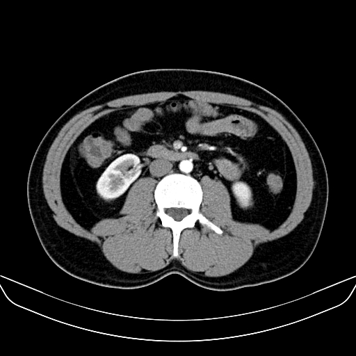 Bilateral accessory renal arteries with mild pelvi-ureteric junction (PUJ) obstruction (Radiopaedia 66357-75596 A 31).jpg