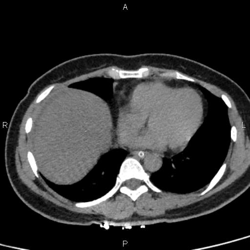 Bilateral adrenal gland hyperenhancement in pancreatitis (Radiopaedia 86642-102753 Axial non-contrast 5).jpg