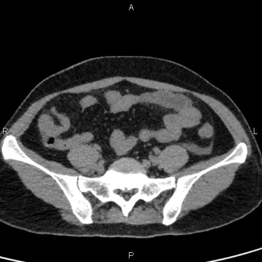 Bilateral adrenal gland hyperenhancement in pancreatitis (Radiopaedia 86642-102753 Axial non-contrast 83).jpg